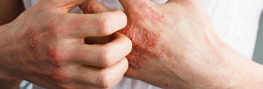 Psoriasis